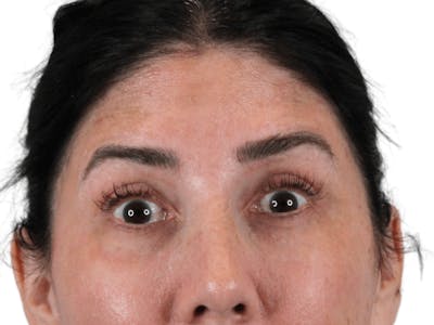 BOTOX  Before & After Gallery - Patient 148367903 - Image 2