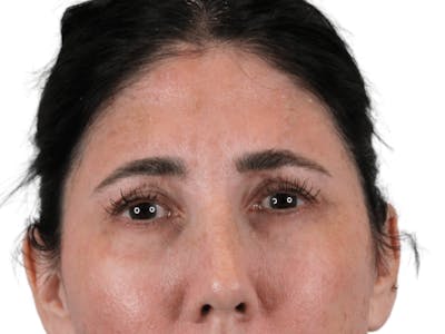 BOTOX  Before & After Gallery - Patient 148367903 - Image 4