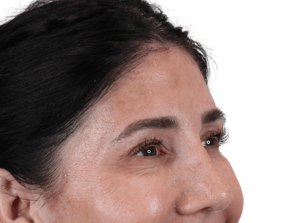 BOTOX  Before & After Gallery - Patient 148367903 - Image 6