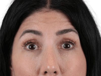 BOTOX  Before & After Gallery - Patient 148367903 - Image 1