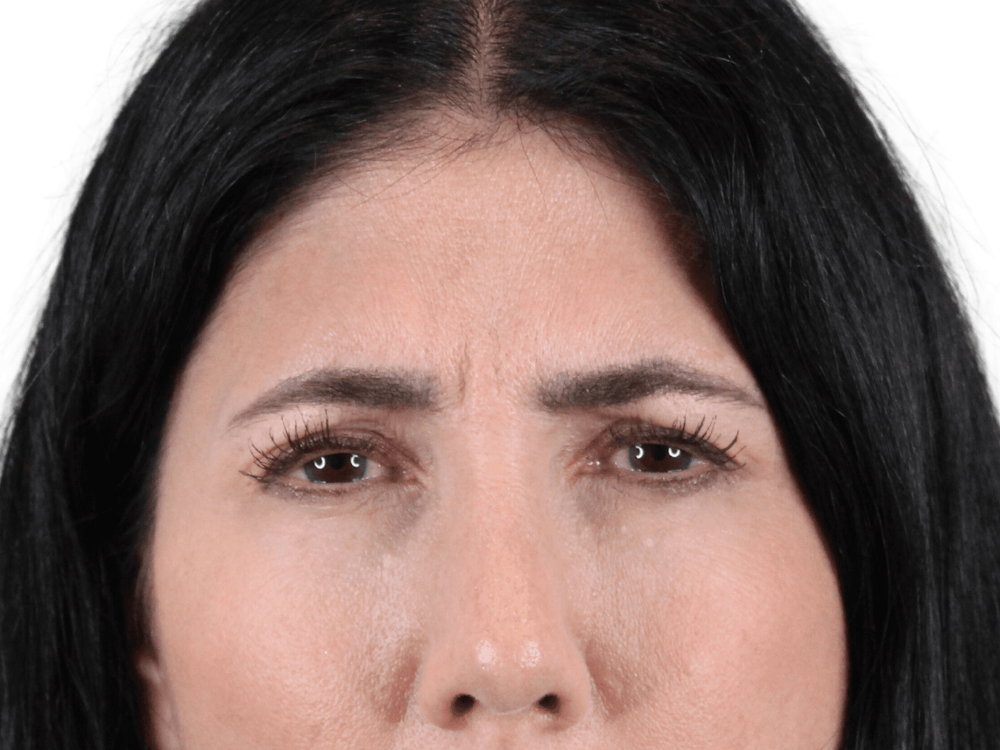 BOTOX  Before & After Gallery - Patient 148367903 - Image 3
