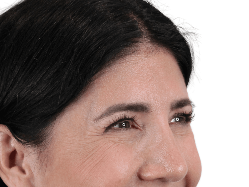 BOTOX  Before & After Gallery - Patient 148367903 - Image 5