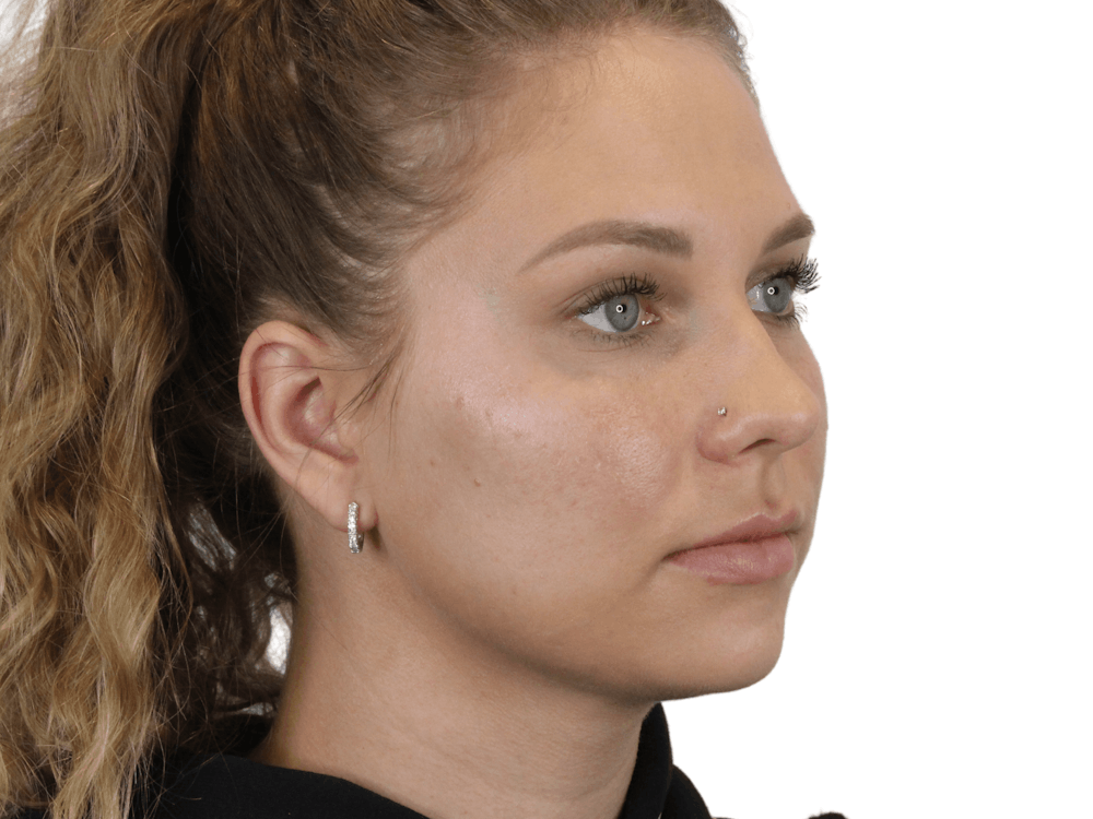 Cheek Filler  Before & After Gallery - Patient 148368025 - Image 2