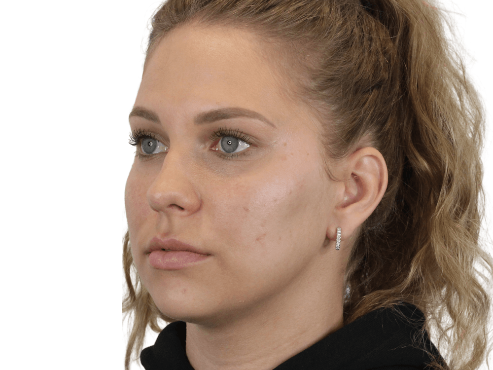Cheek Filler  Before & After Gallery - Patient 148368025 - Image 4