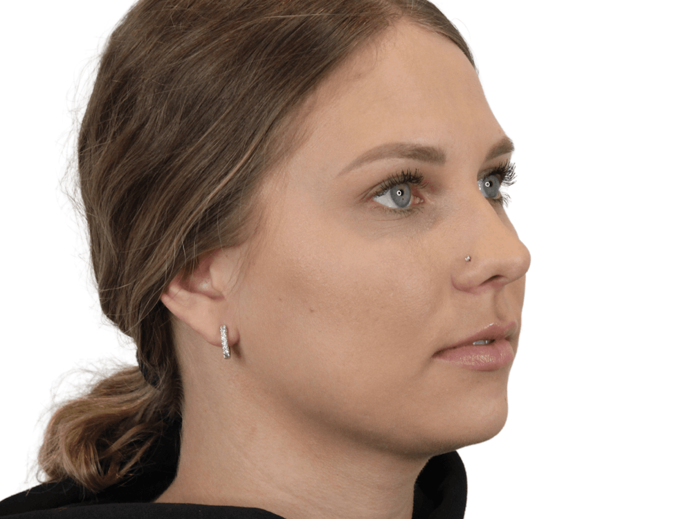 Cheek Filler  Before & After Gallery - Patient 148368025 - Image 1