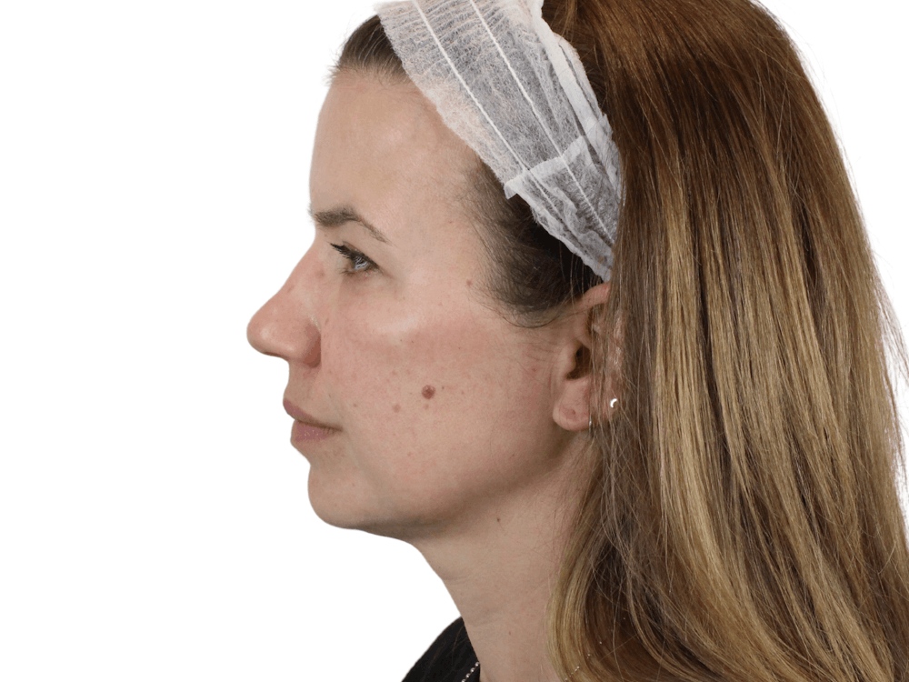 Cheek Filler  Before & After Gallery - Patient 148368027 - Image 2