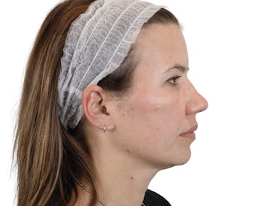 Cheek Filler  Before & After Gallery - Patient 148368027 - Image 4