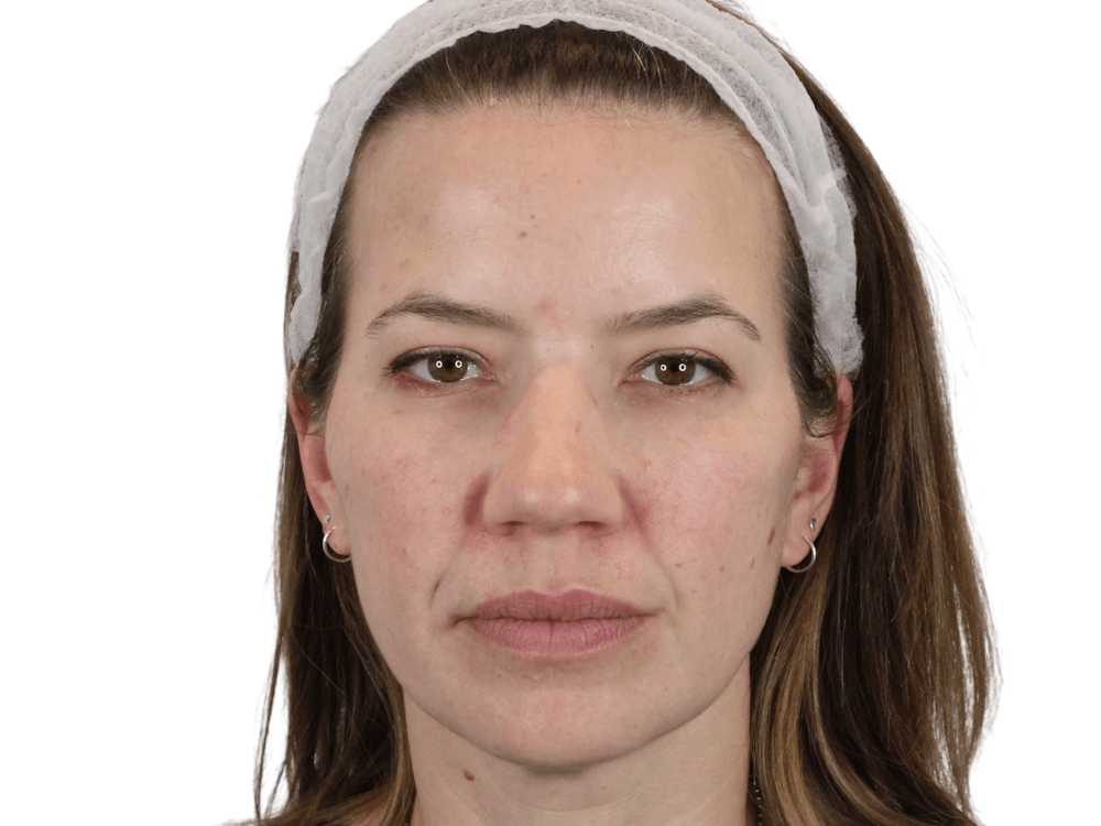 Cheek Filler  Before & After Gallery - Patient 148368027 - Image 10