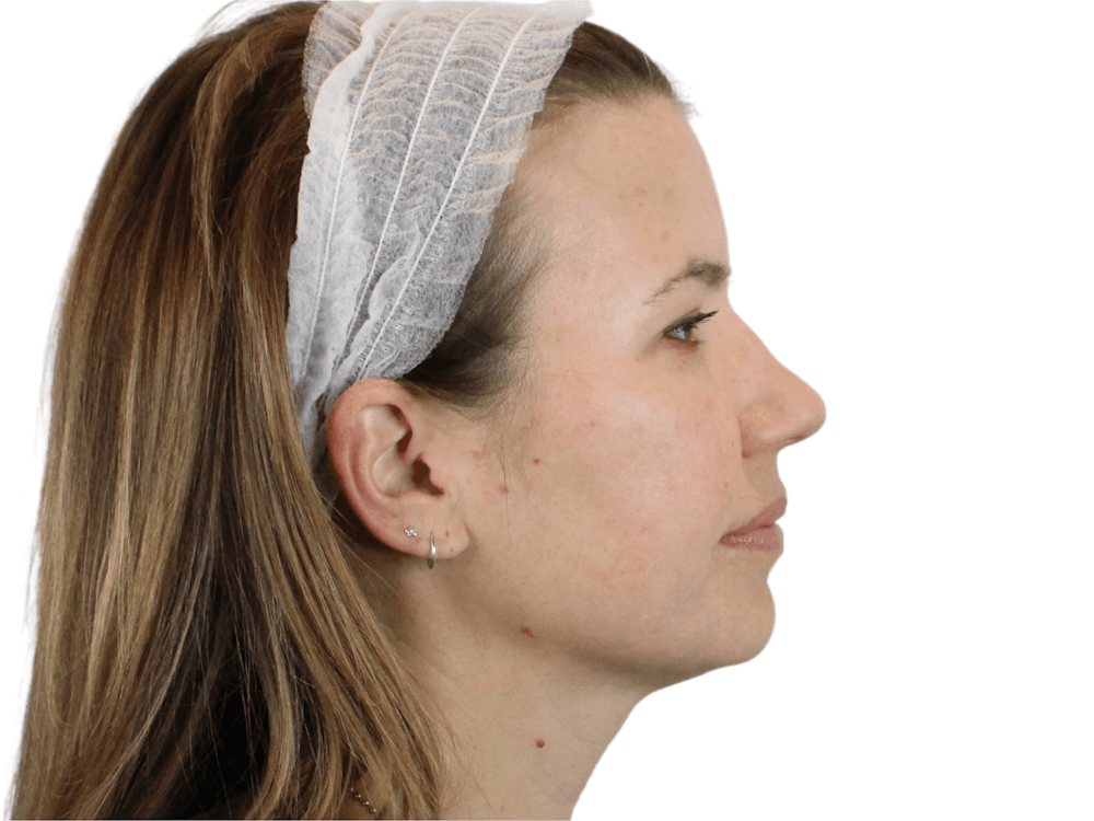 Cheek Filler  Before & After Gallery - Patient 148368027 - Image 3