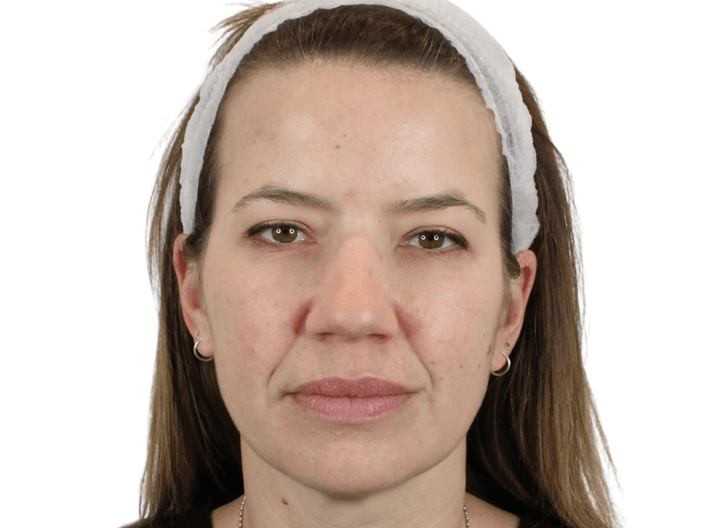 Cheek Filler  Before & After Gallery - Patient 148368027 - Image 9