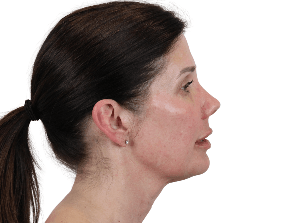 Chin Filler Before & After Gallery - Patient 148368270 - Image 2