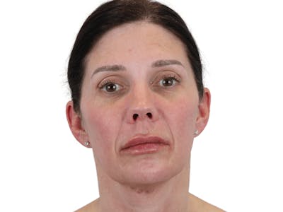 Chin Filler Before & After Gallery - Patient 148368270 - Image 4