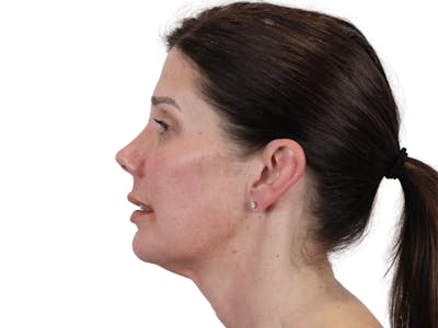 Cheek Filler  Before & After Gallery - Patient 148368026 - Image 6