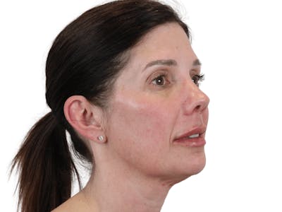 Chin Filler Before & After Gallery - Patient 148368270 - Image 8