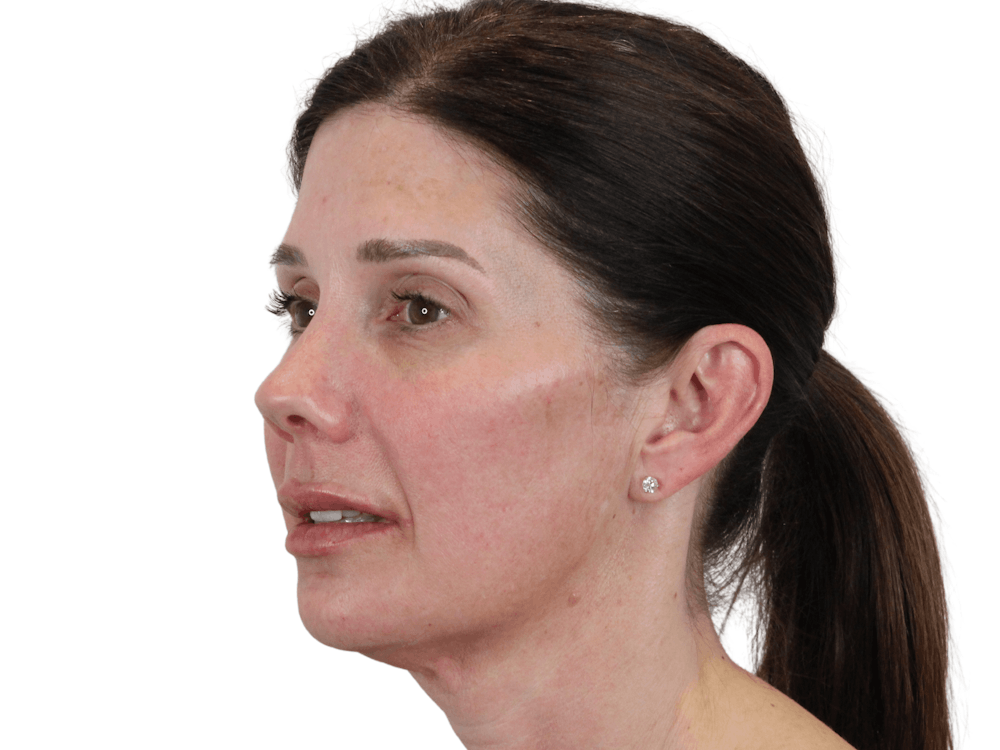 Cheek Filler  Before & After Gallery - Patient 148368026 - Image 10