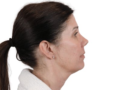 Cheek Filler  Before & After Gallery - Patient 148368026 - Image 1