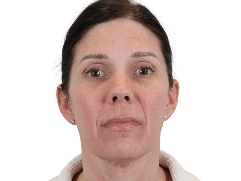Cheek Filler  Before & After Gallery - Patient 148368026 - Image 3