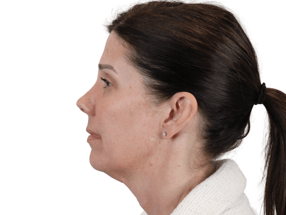 Cheek Filler  Before & After Gallery - Patient 148368026 - Image 5