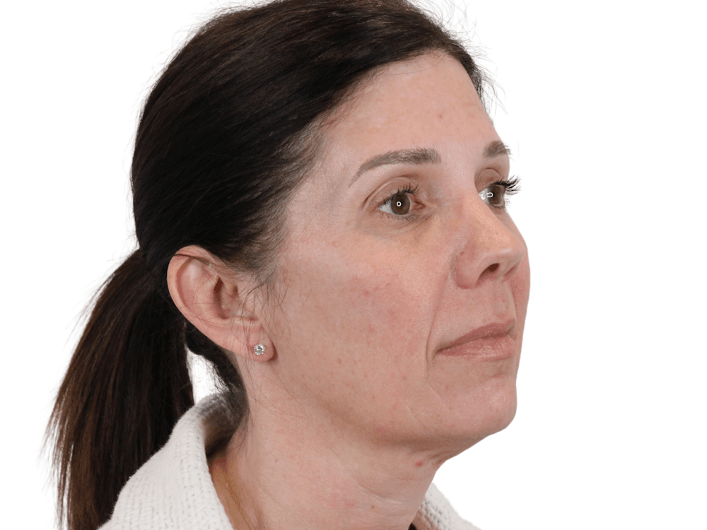 Cheek Filler  Before & After Gallery - Patient 148368026 - Image 7