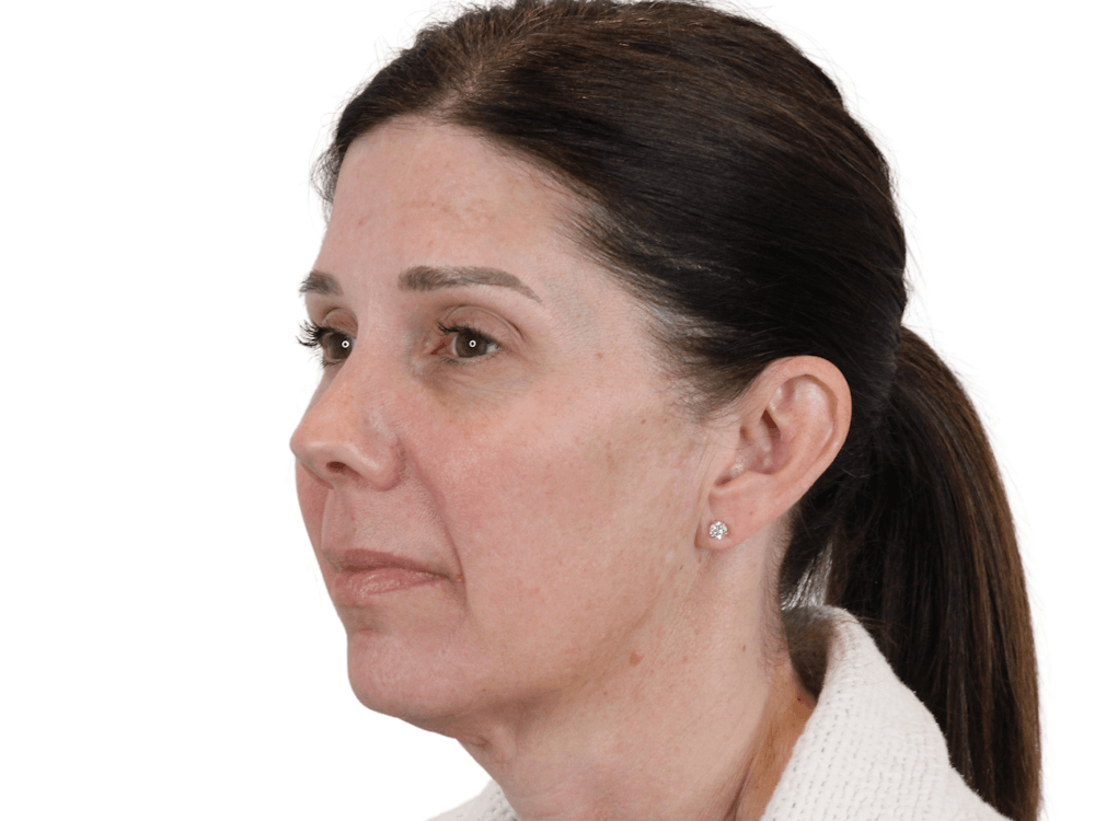 Chin Filler Before & After Gallery - Patient 148368270 - Image 9