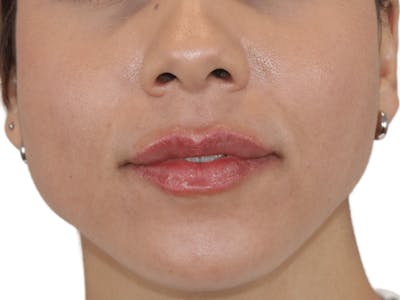 Lip Filler Before & After Gallery - Patient 148368245 - Image 2