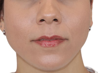 Lip Filler Before & After Gallery - Patient 148368245 - Image 1