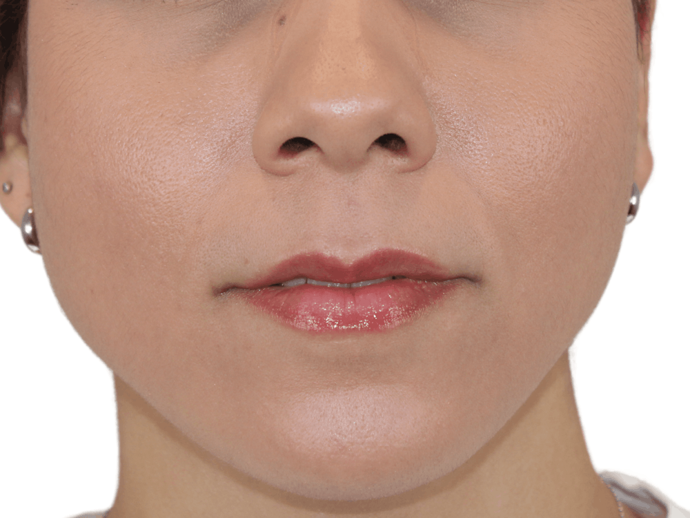 Lip Filler Before & After Gallery - Patient 148368245 - Image 1