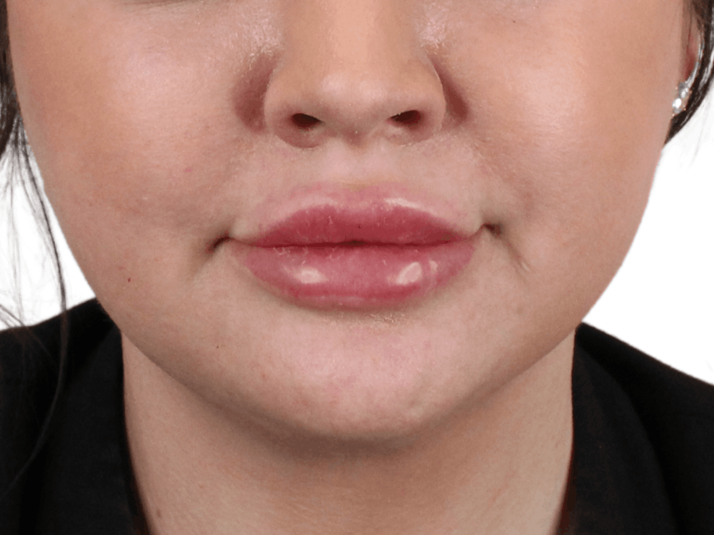 Lip Filler Before & After Gallery - Patient 148368244 - Image 2