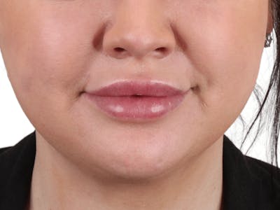 Lip Filler Before & After Gallery - Patient 148368244 - Image 1