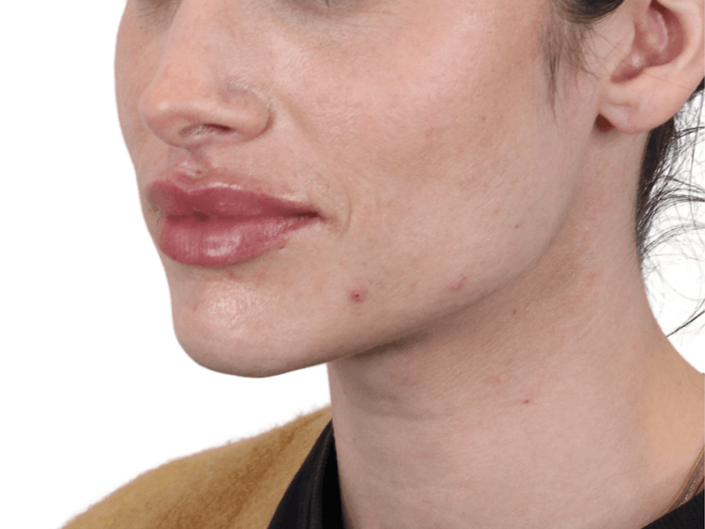 Lip Filler Before & After Gallery - Patient 148368243 - Image 2