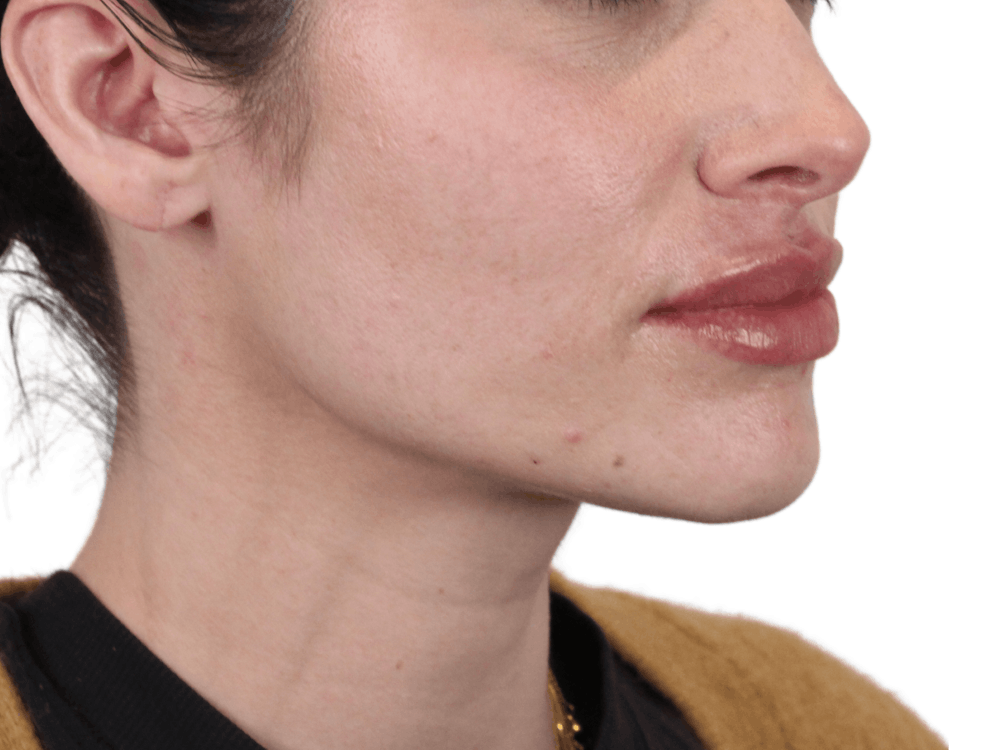 Lip Filler Before & After Gallery - Patient 148368243 - Image 4