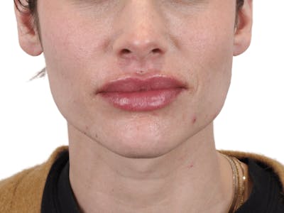 Lip Filler Before & After Gallery - Patient 148368243 - Image 6