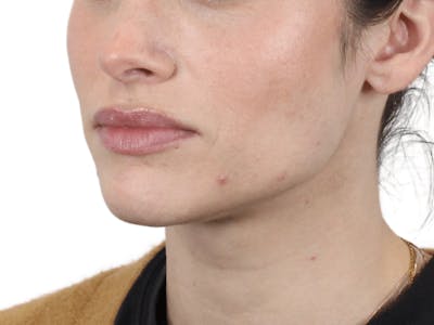 Lip Filler Before & After Gallery - Patient 148368243 - Image 1