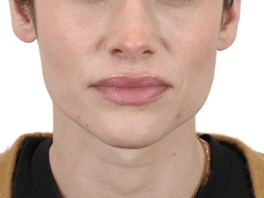 Lip Filler Before & After Gallery - Patient 148368243 - Image 5