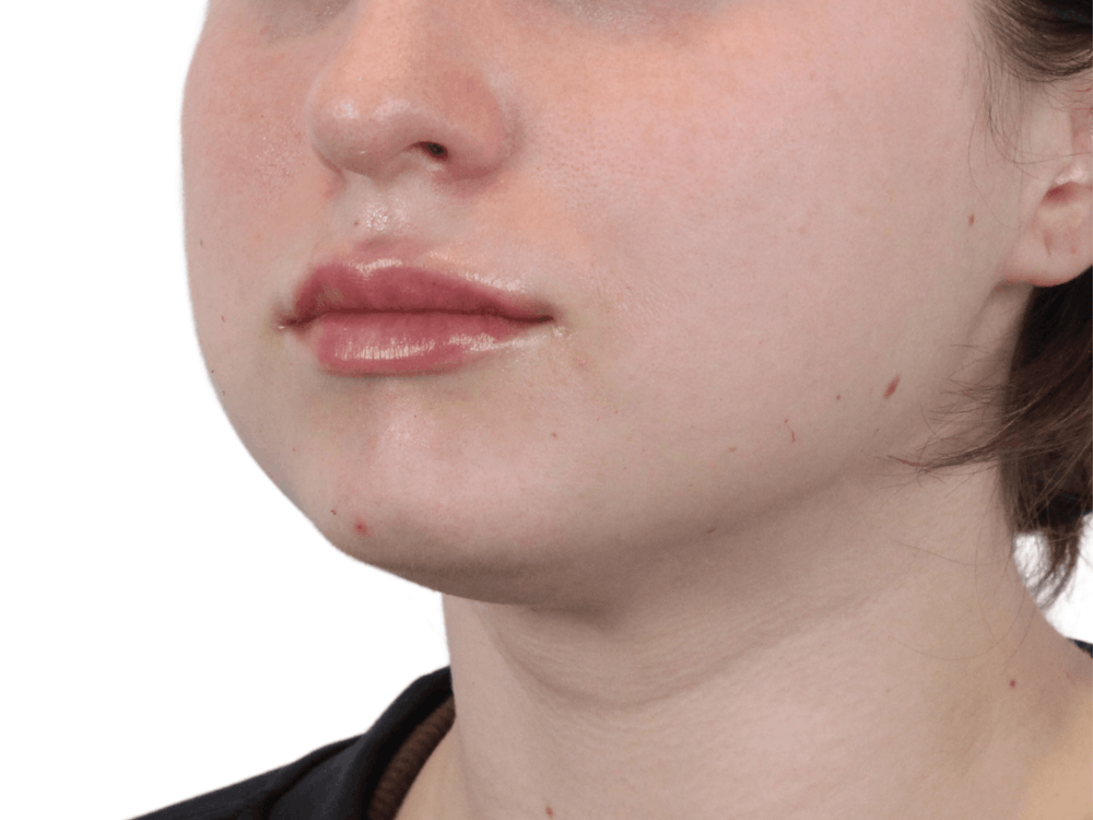 Lip Filler Before & After Gallery - Patient 148368242 - Image 2