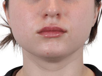 Lip Filler Before & After Gallery - Patient 148368242 - Image 6