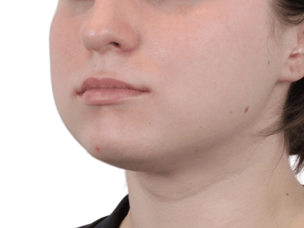 Lip Filler Before & After Gallery - Patient 148368242 - Image 1