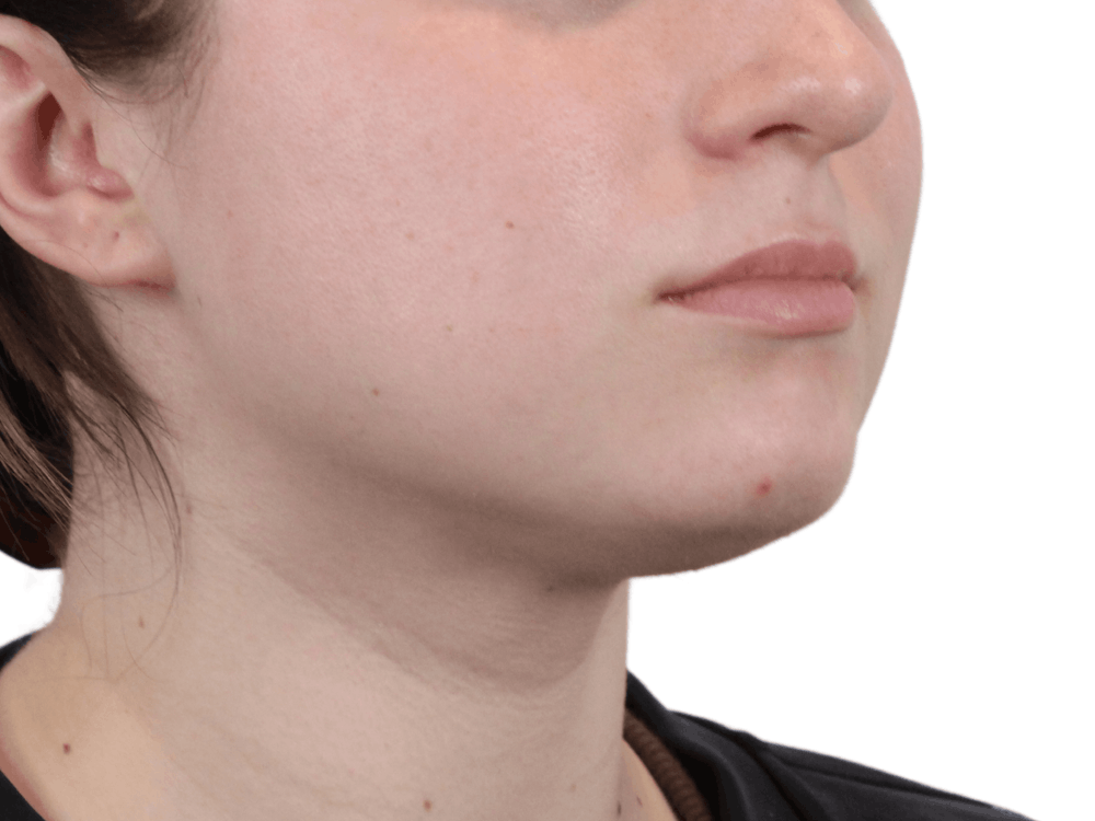 Lip Filler Before & After Gallery - Patient 148368242 - Image 3