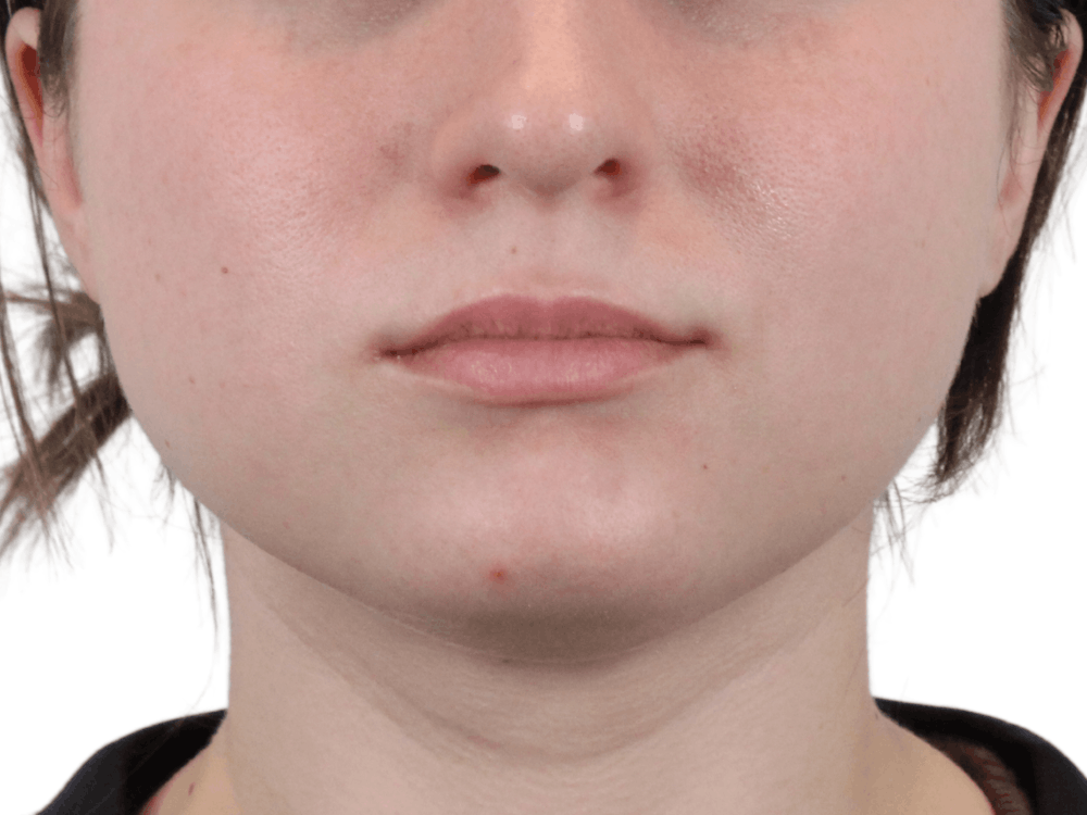 Lip Filler Before & After Gallery - Patient 148368242 - Image 5
