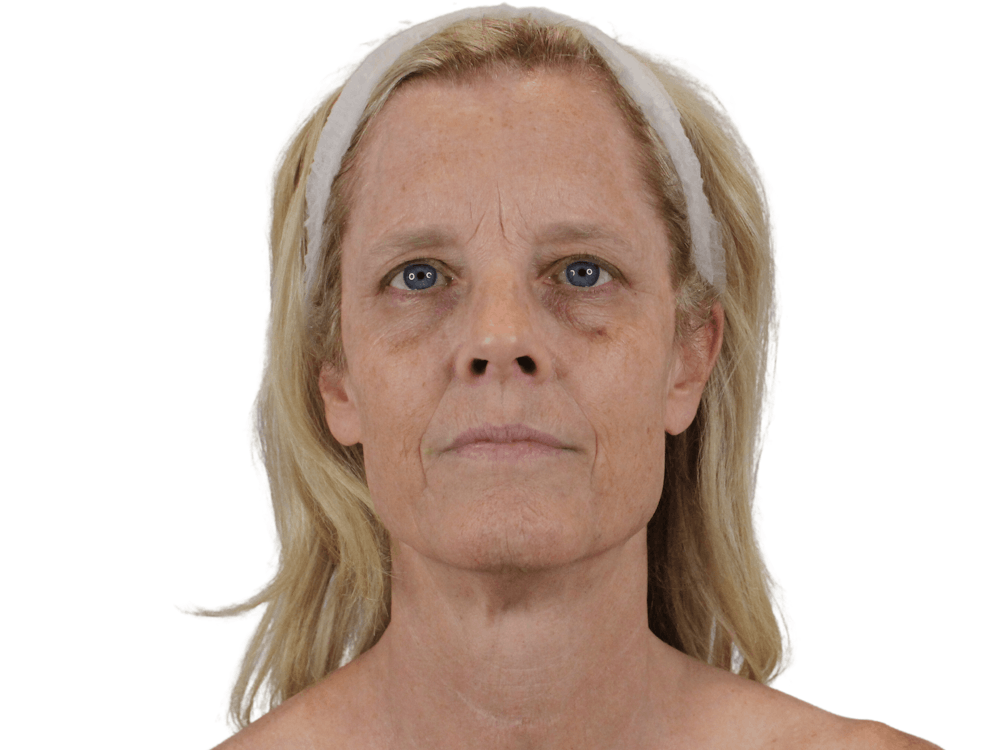 Sciton BBL HERO® Before & After Gallery - Patient 148368323 - Image 11