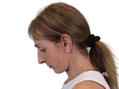 Deep Neck Lift Before & After Gallery - Patient 148519137 - Image 6