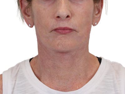 Deep Neck Lift Before & After Gallery - Patient 148519137 - Image 2