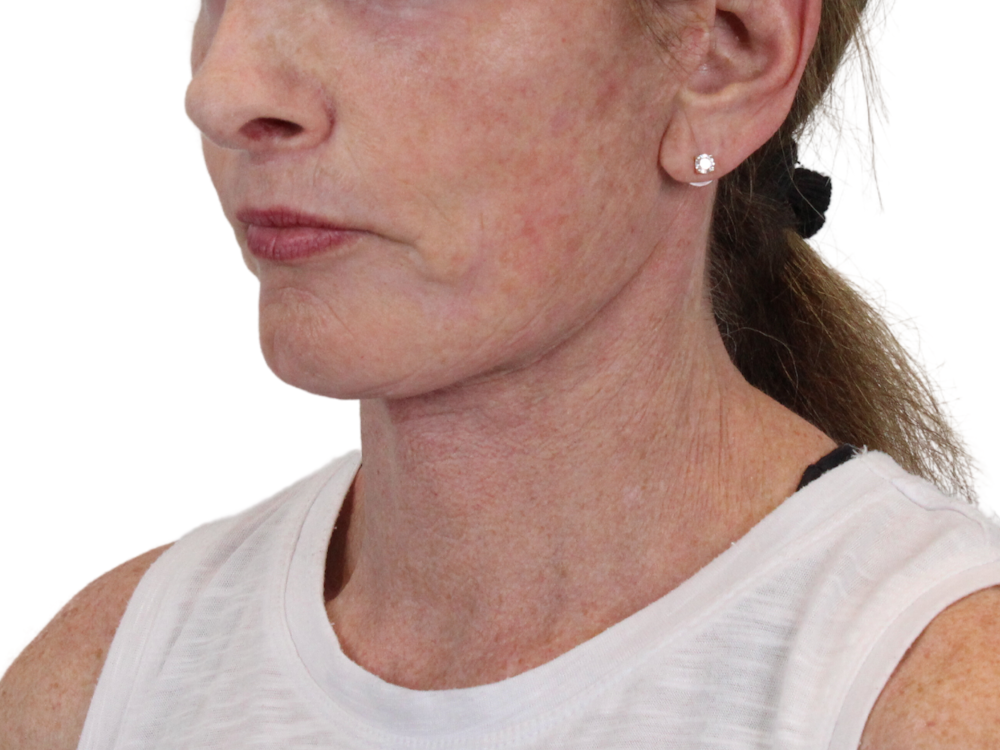 Deep Neck Lift Before & After Gallery - Patient 148519137 - Image 4