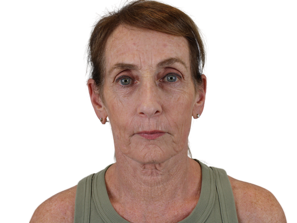 Deep Plane Facelift Before & After Gallery - Patient 148519134 - Image 1