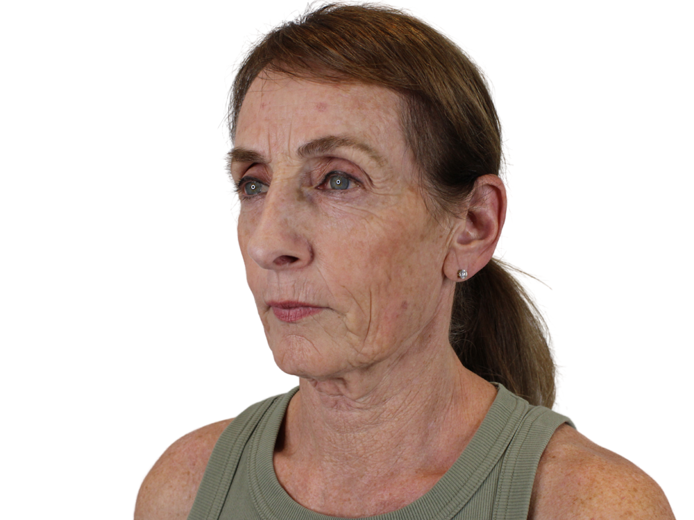 Deep Plane Facelift Before & After Gallery - Patient 148519134 - Image 3