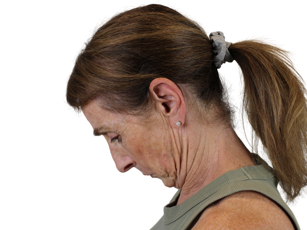Deep Neck Lift Before & After Gallery - Patient 148519137 - Image 5