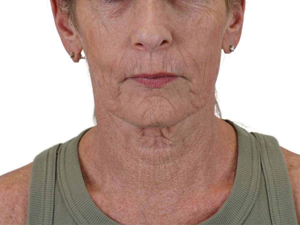 Lip Lift Before & After Gallery - Patient 148519142 - Image 1