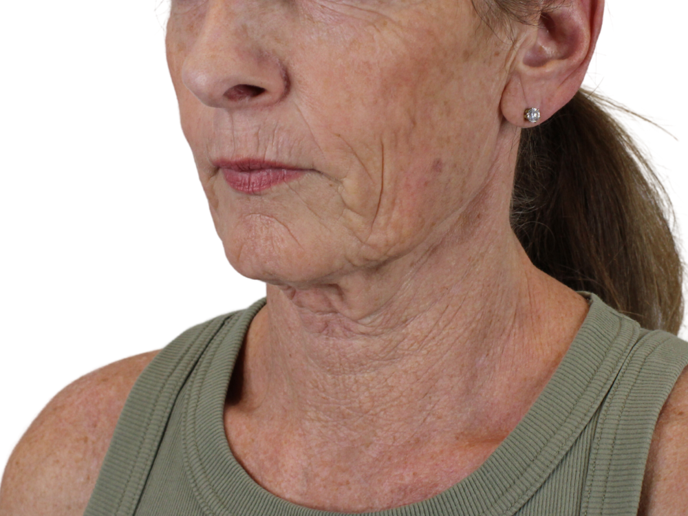 Deep Neck Lift Before & After Gallery - Patient 148519137 - Image 9