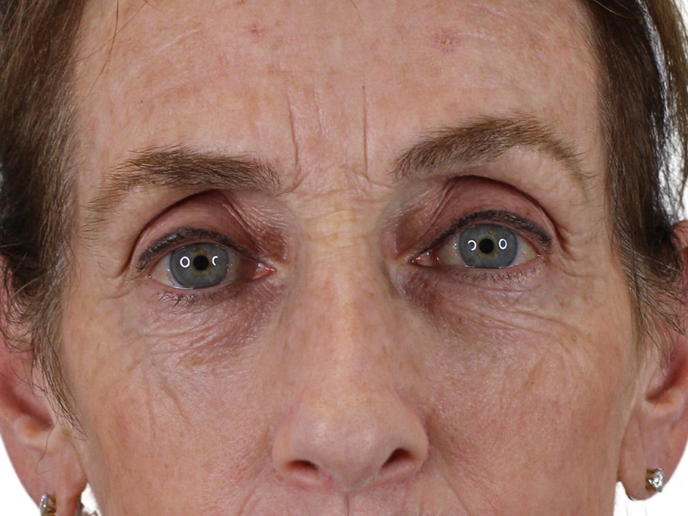 Blepharoplasty Before & After Gallery - Patient 148519228 - Image 1