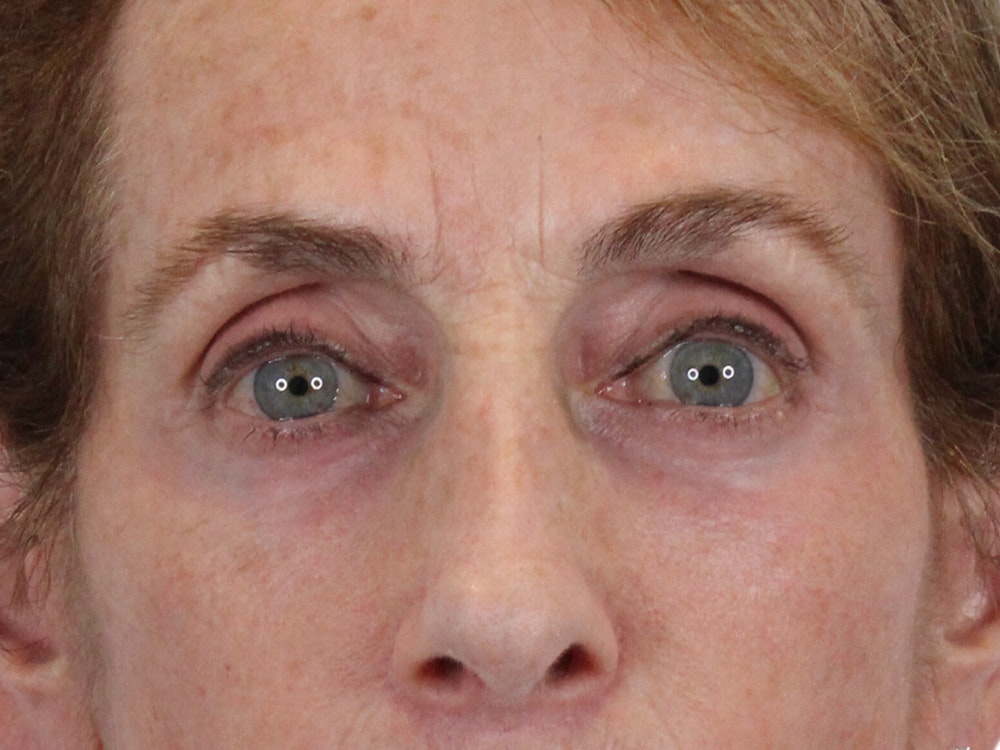 Blepharoplasty Before & After Gallery - Patient 148519228 - Image 2